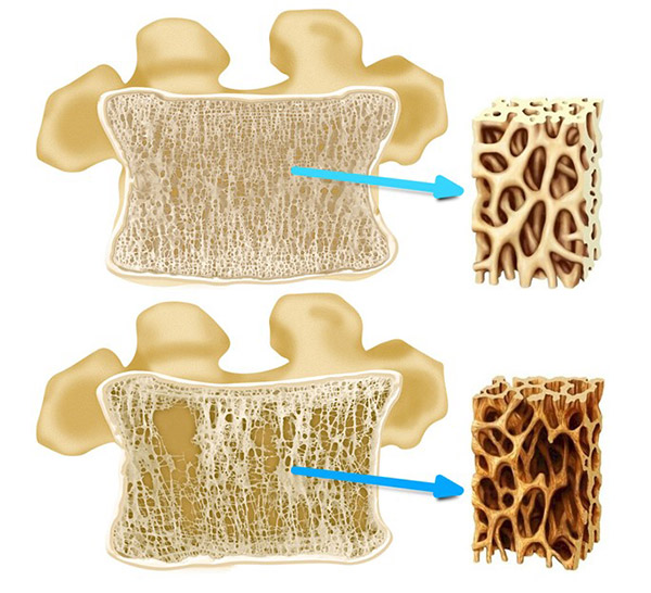 osteoporosi01