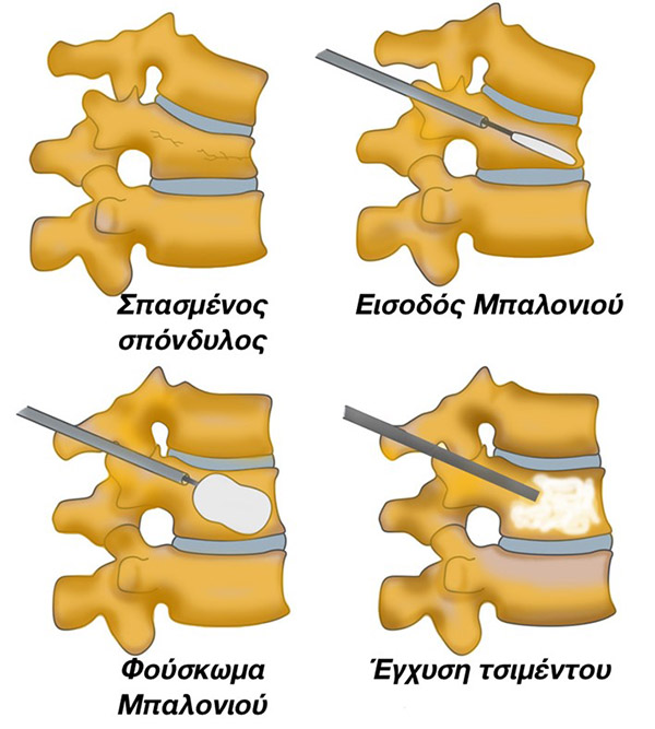 osteoporosi02